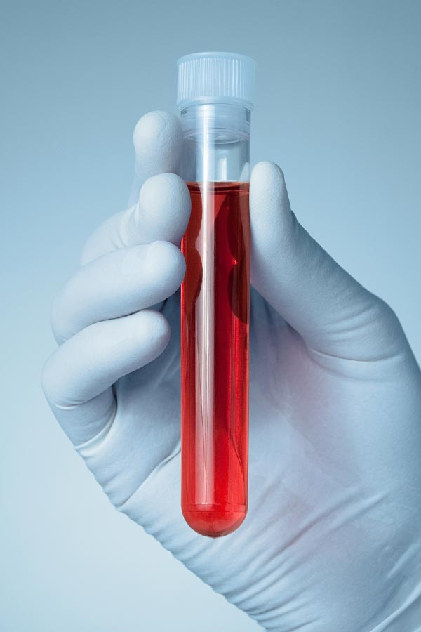 Autoimmune-Treatment Close up of a gloved hand holding a vial of red liquid, representing Dr. Stephanie King's comprehensive autoimmune disorder treatment in Salt Lake City.