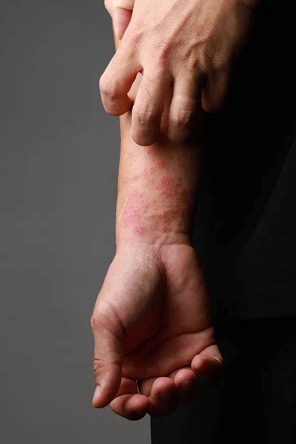 Eczema-Treatment One hand scratches an area irritated by eczema on the other wrist. Get treatment for eczema from Dr. Stephanie King in Salt Lake City.