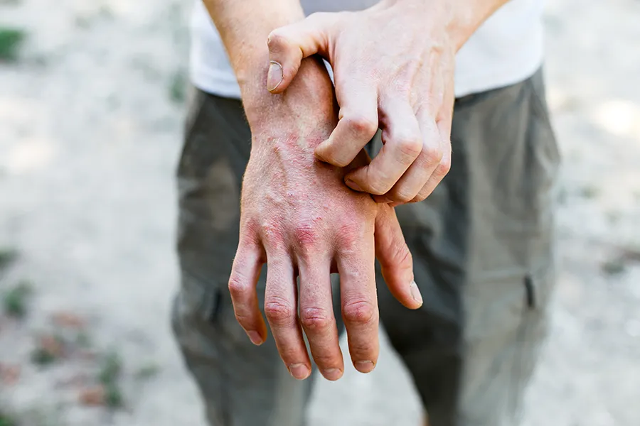 Psoriasis-Clinic Close-up of a man scratching his hands while experiencing Psoriasis. Get care for Psoriasis from Dr. Stephanie King in Salt Lake City.