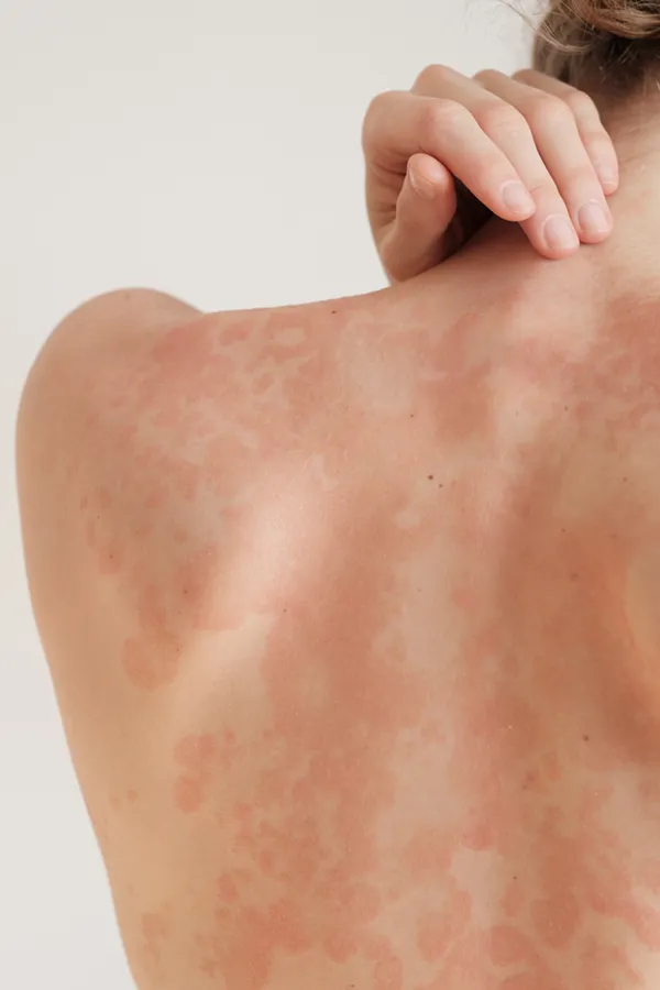 Psoriasis-Treatment The back and shoulder of a woman experiencing Psoriasis. Get treatment for Psoriasis from Dr. Stephanie King in Salt Lake City.