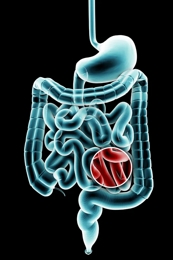 Ulcerative-Colitis-Treatment 3D illustration of the digestive system in blue tones, with an area of discomfort in red tones. Get treatment for Ulcerative Colitis from Dr. Stephanie King in Salt Lake City.